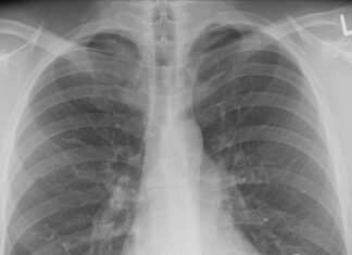 Lungenkrebs: Häufig, tödlich – und noch immer unterschätzt
